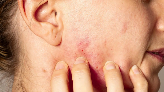 Person checking irritated skin — a relatable moment of dealing with retinol side effects